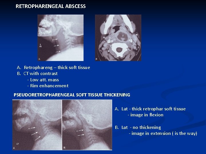 RETROPHARENGEAL ABSCESS A. Retrophareng – thick soft tissue B. CT with contrast - Low