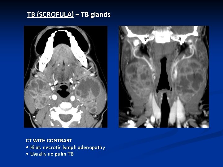 TB (SCROFULA) – TB glands CT WITH CONTRAST • Bilat. necrotic lymph adenopathy •