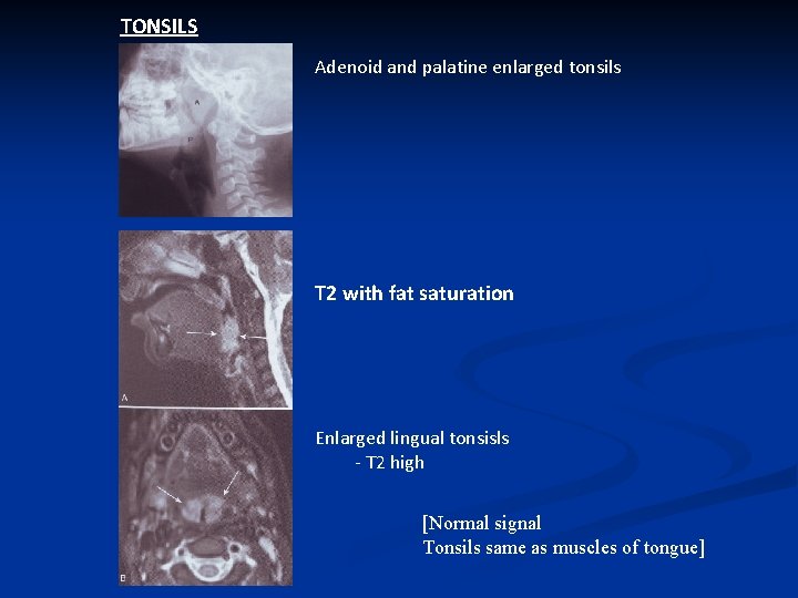 TONSILS Adenoid and palatine enlarged tonsils T 2 with fat saturation Enlarged lingual tonsisls