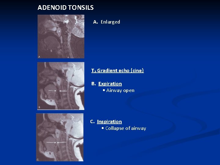 ADENOID TONSILS A. Enlarged T₂ Gradient echo (cine) B. Expiration • Airway open C.