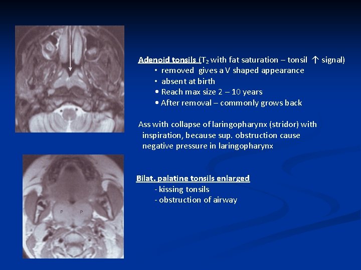 Adenoid tonsils (T₂ with fat saturation – tonsil ↑ signal) • removed gives a