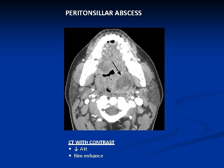 PERITONSILLAR ABSCESS CT WITH CONTRAST • ↓ Att • Rim enhance 