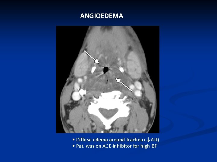 ANGIOEDEMA • Diffuse edema around trachea (↓Att) • Pat. was on ACE-inhibitor for high