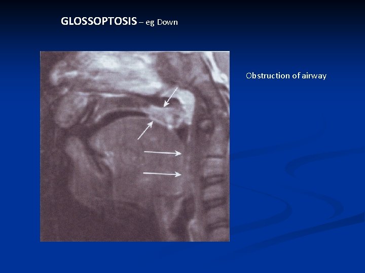 GLOSSOPTOSIS – eg Down Obstruction of airway 