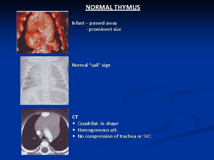 NORMAL THYMUS Infant – passed away - prominent size Normal “sail” sign CT •