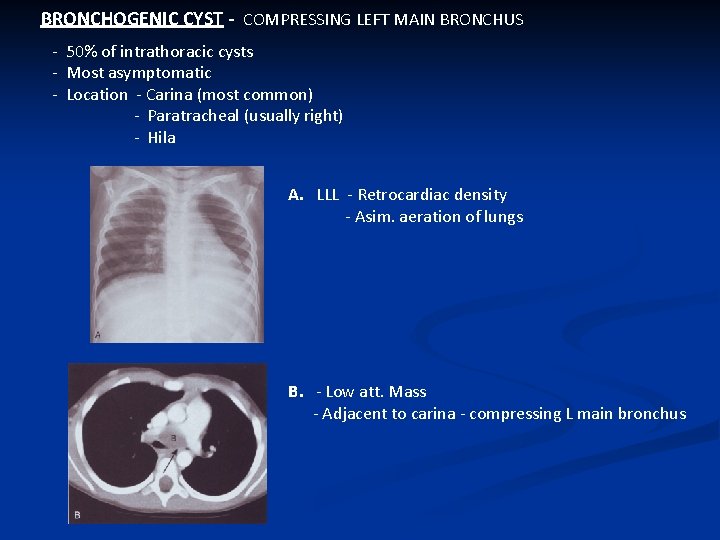 BRONCHOGENIC CYST - COMPRESSING LEFT MAIN BRONCHUS - 50% of intrathoracic cysts - Most