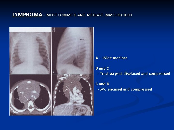 LYMPHOMA – MOST COMMON ANT. MEDIAST. MASS IN CHILD A - Wide mediast. B