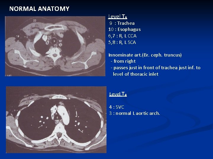 NORMAL ANATOMY Level T₃ 9 : Trachea 10 : Esophagus 6, 7 : R,