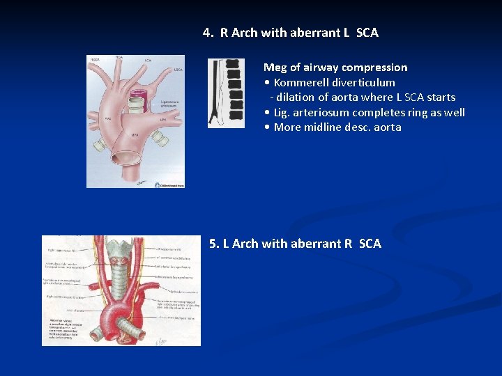 4. R Arch with aberrant L SCA Meg of airway compression • Kommerell diverticulum