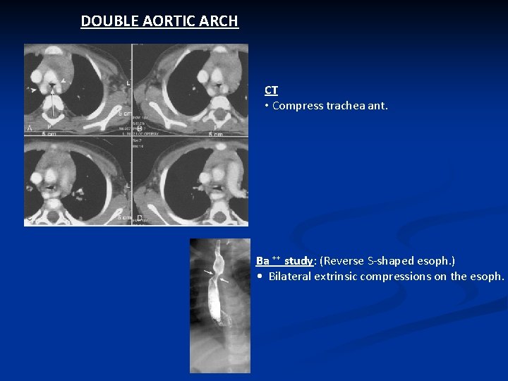 DOUBLE AORTIC ARCH CT • Compress trachea ant. Ba ⁺⁺ study: (Reverse S-shaped esoph.