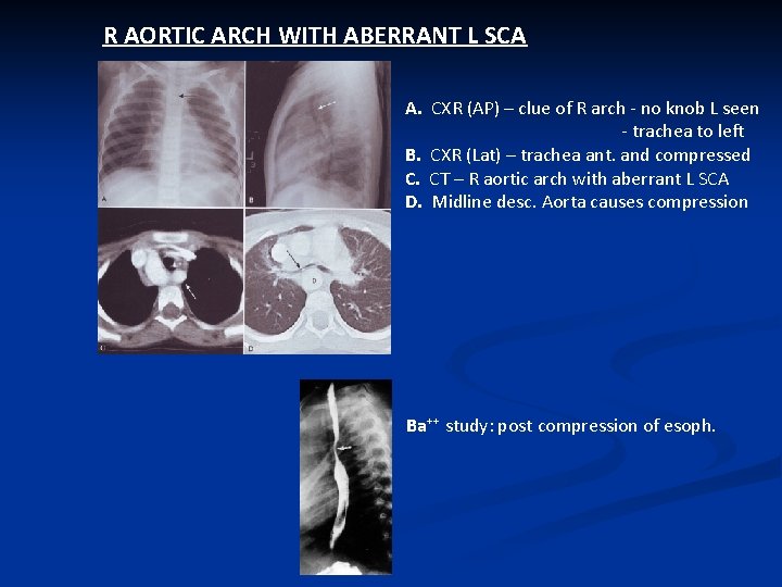 R AORTIC ARCH WITH ABERRANT L SCA A. CXR (AP) – clue of R