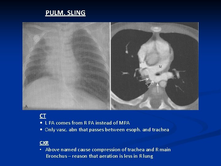 PULM. SLING CT • L PA comes from R PA instead of MPA •