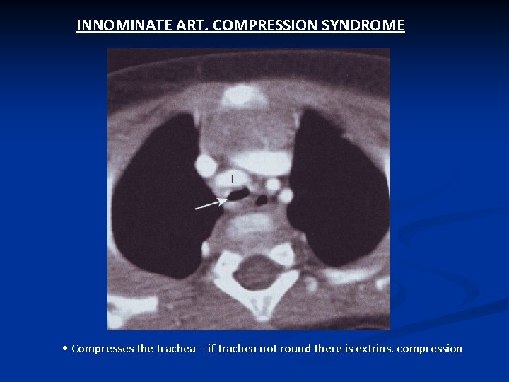 INNOMINATE ART. COMPRESSION SYNDROME • Compresses the trachea – if trachea not round there