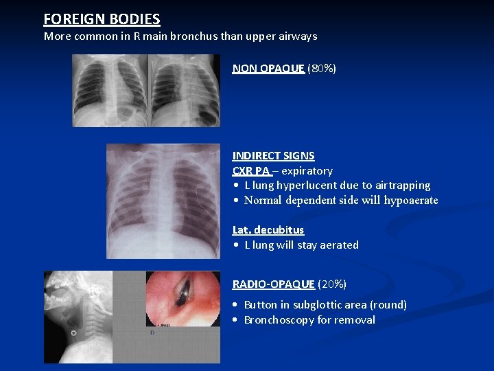 FOREIGN BODIES More common in R main bronchus than upper airways NON OPAQUE (80%)