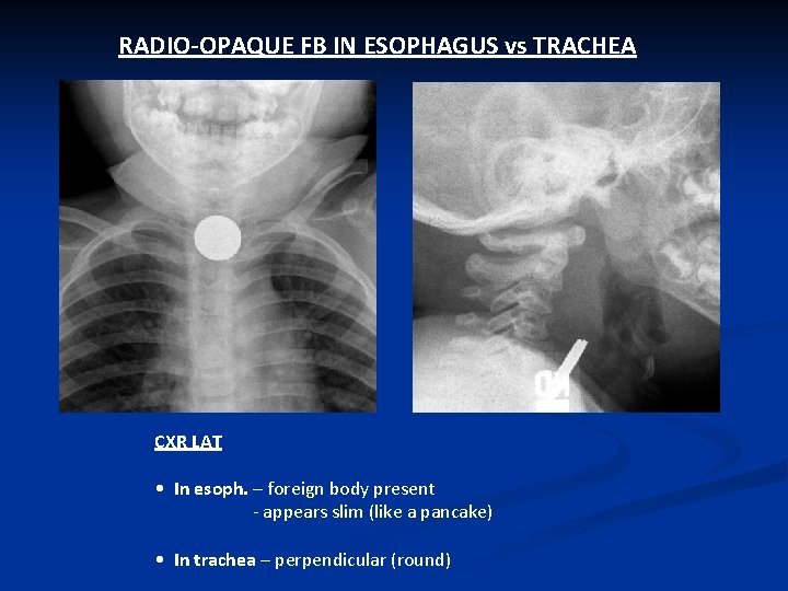 RADIO-OPAQUE FB IN ESOPHAGUS vs TRACHEA CXR LAT • In esoph. – foreign body