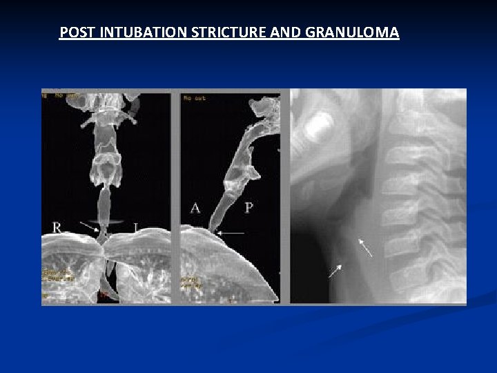 POST INTUBATION STRICTURE AND GRANULOMA 