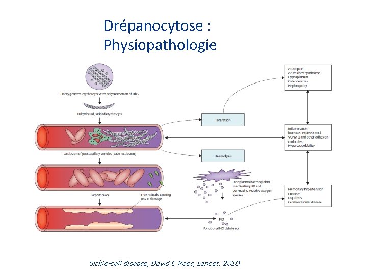 Drépanocytose : Physiopathologie Sickle-cell disease, David C Rees, Lancet, 2010 
