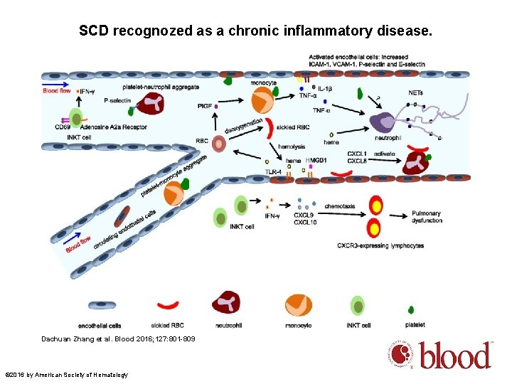 SCD recognozed as a chronic inflammatory disease. Dachuan Zhang et al. Blood 2016; 127:
