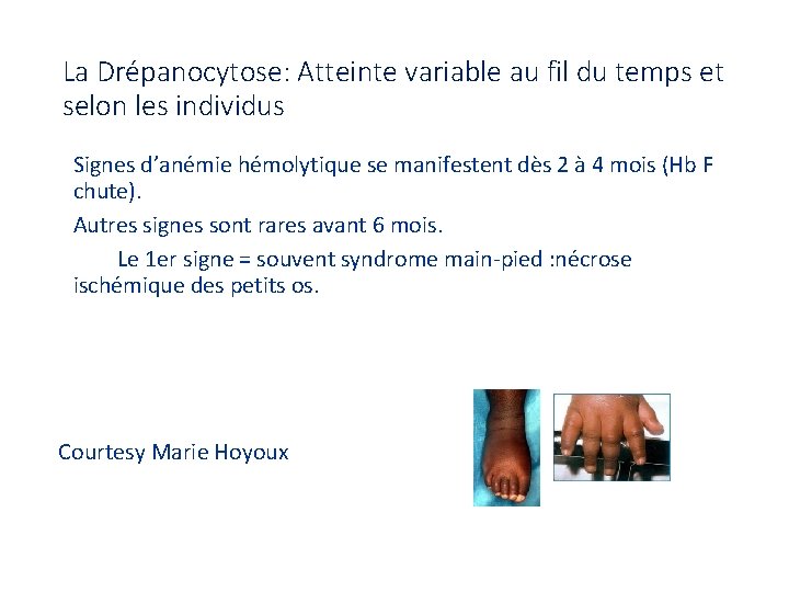 La Drépanocytose: Atteinte variable au fil du temps et selon les individus Signes d’anémie
