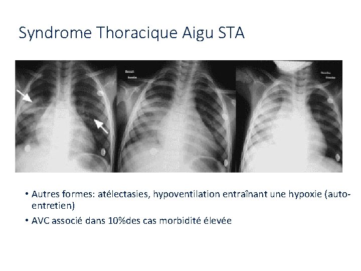 Syndrome Thoracique Aigu STA • Autres formes: atélectasies, hypoventilation entraînant une hypoxie (autoentretien) •