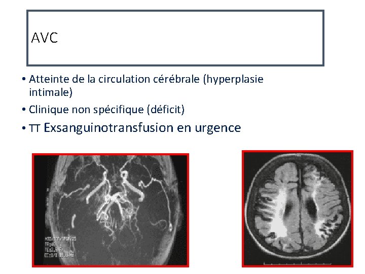 AVC • Atteinte de la circulation cérébrale (hyperplasie intimale) • Clinique non spécifique (déficit)