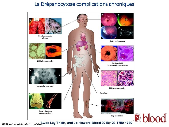 La Drépanocytose complications chroniques Swee © 2018 by American Society of Hematology Lay Thein,