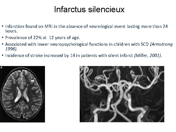 Infarctus silencieux • Infarction found on MRI in the absence of neurological event lasting