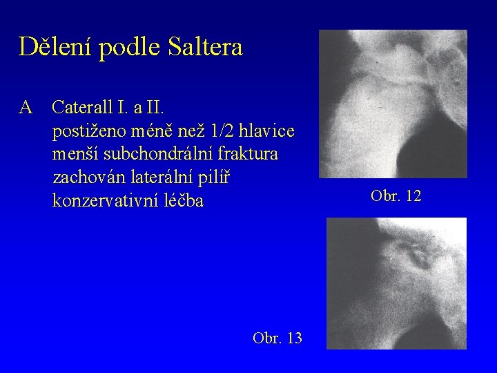 Dělení podle Saltera A Caterall I. a II. postiženo méně než 1/2 hlavice menší