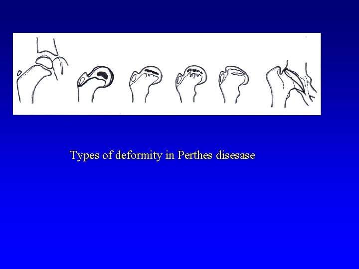 Types of deformity in Perthes disesase 