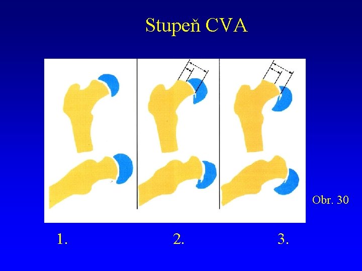 Stupeň CVA Obr. 30 1. 2. 3. 