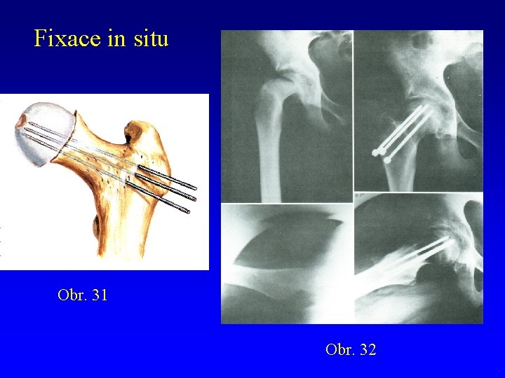 Fixace in situ Obr. 31 Obr. 32 