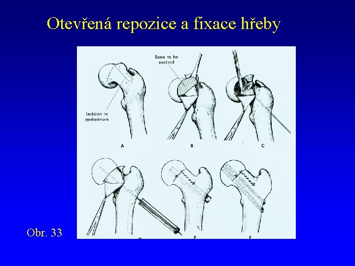 Otevřená repozice a fixace hřeby Obr. 33 