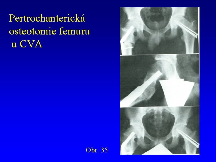 Pertrochanterická osteotomie femuru u CVA Obr. 35 