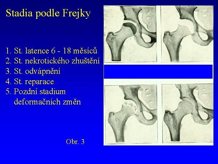 Stadia podle Frejky 1. St. latence 6 - 18 měsíců 2. St. nekrotického zhuštění