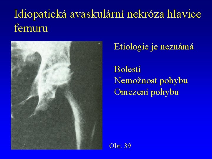 Idiopatická avaskulární nekróza hlavice femuru Etiologie je neznámá Bolesti Nemožnost pohybu Omezení pohybu Obr.