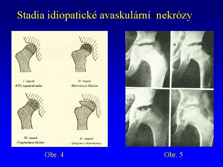 Stadia idiopatické avaskulární nekrózy Obr. 4 Obr. 5 