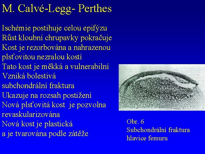 M. Calvé-Legg- Perthes Ischémie postihuje celou epifýzu Růst kloubní chrupavky pokračuje Kost je rezorbována