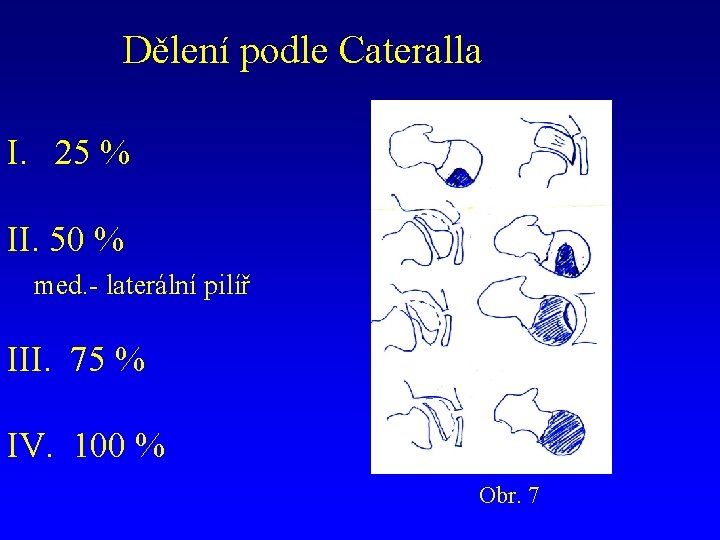 Dělení podle Cateralla I. 25 % II. 50 % med. - laterální pilíř III.