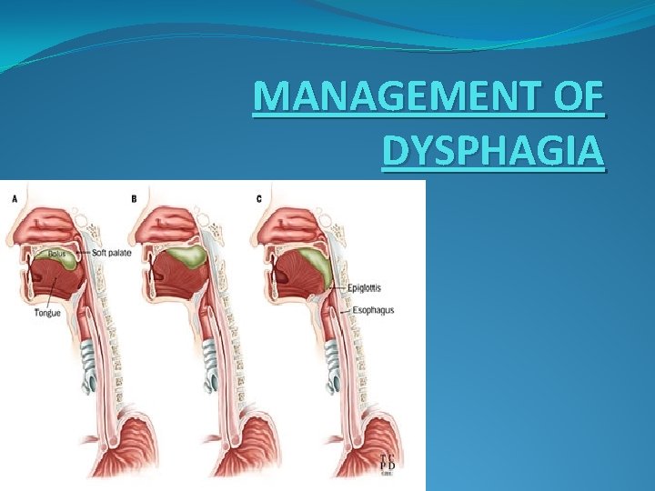 MANAGEMENT OF DYSPHAGIA 