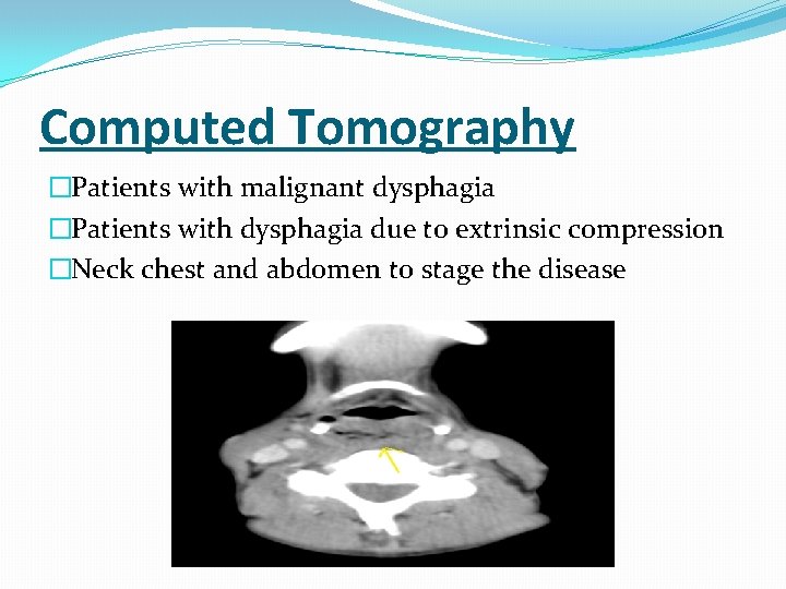 Computed Tomography �Patients with malignant dysphagia �Patients with dysphagia due to extrinsic compression �Neck