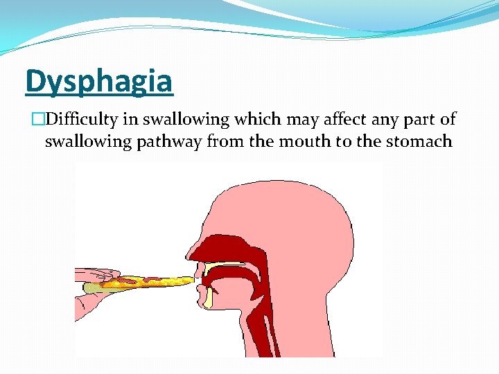 Dysphagia �Difficulty in swallowing which may affect any part of swallowing pathway from the