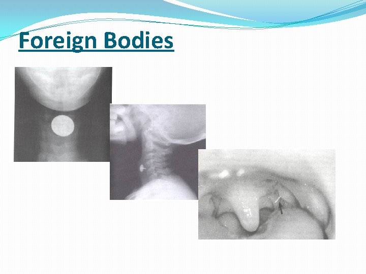 Foreign Bodies 