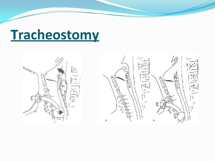 Tracheostomy 