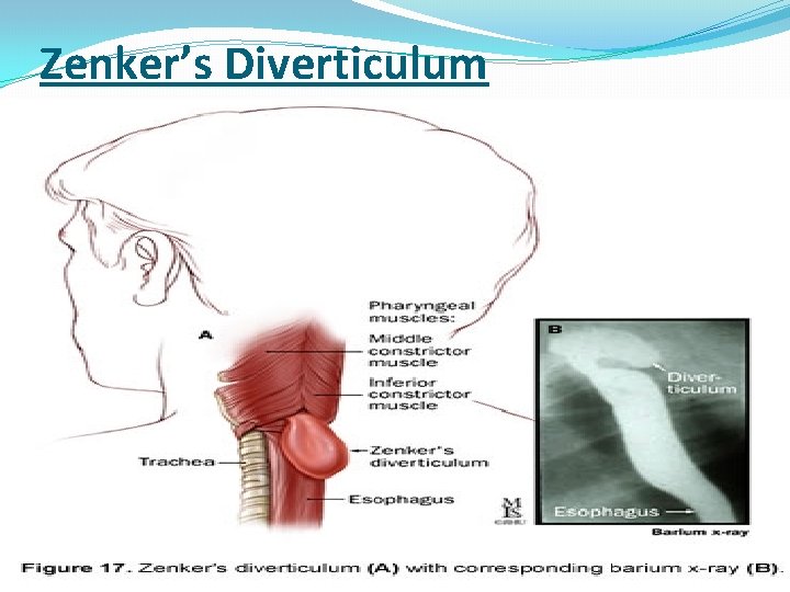 Zenker’s Diverticulum 