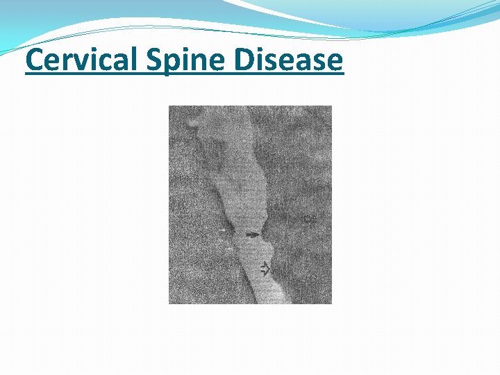Cervical Spine Disease 