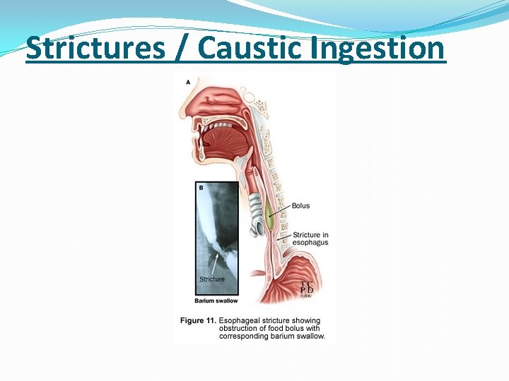 Strictures / Caustic Ingestion 
