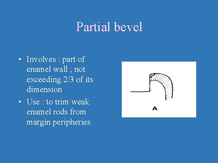 Partial bevel • Involves : part of enamel wall ; not exceeding 2/3 of