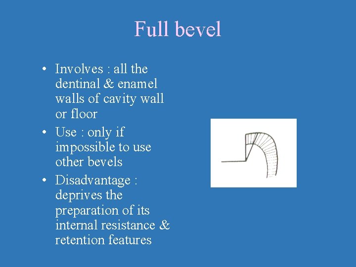 Full bevel • Involves : all the dentinal & enamel walls of cavity wall