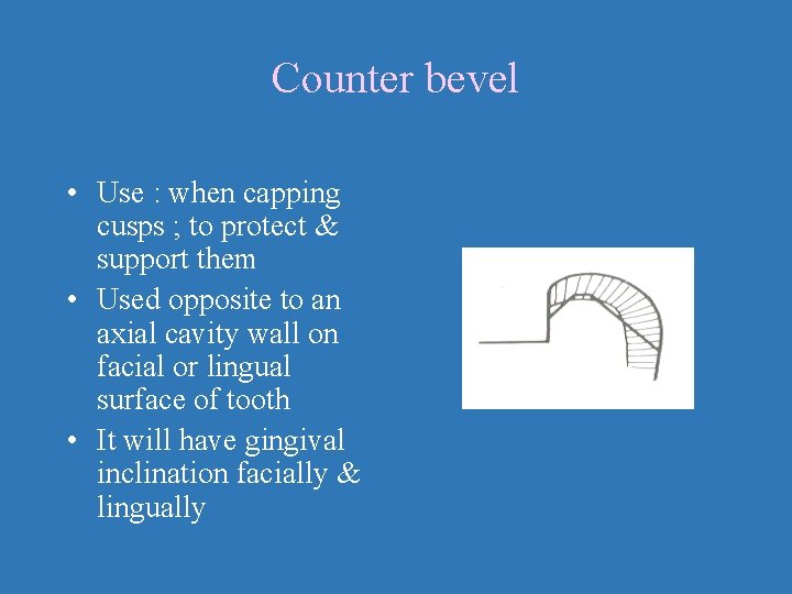 Counter bevel • Use : when capping cusps ; to protect & support them