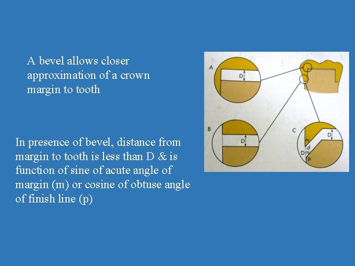 A bevel allows closer approximation of a crown margin to tooth In presence of